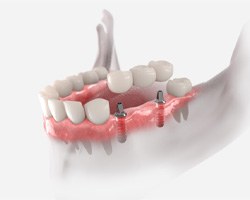 An illustration of an implant dental bridge in downtown Boston