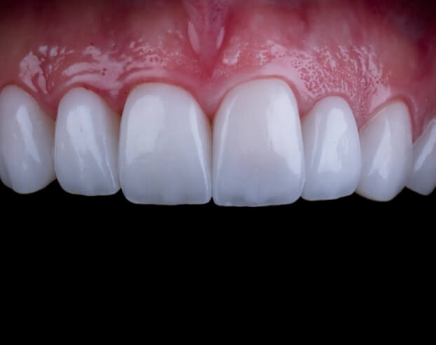 Closeup of healthy smile after metal free dental crown restoration