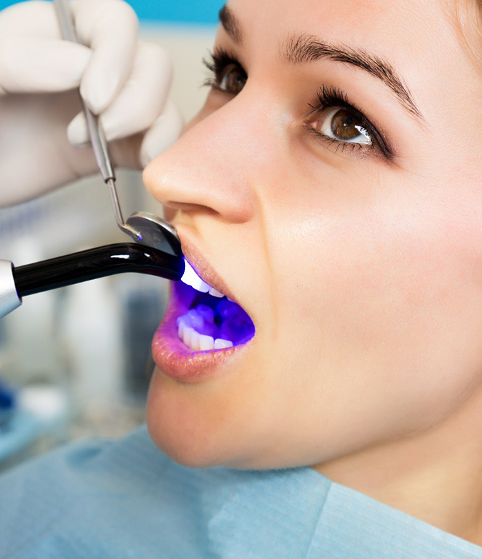 a dentist curing composite resin in a patient’s mouth