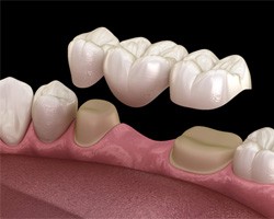 A 3D illustration of a traditional dental bridge in downtown Boston