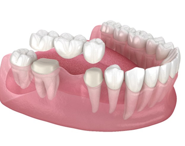 A 3D illustration of a dental bridge in downtown Boston