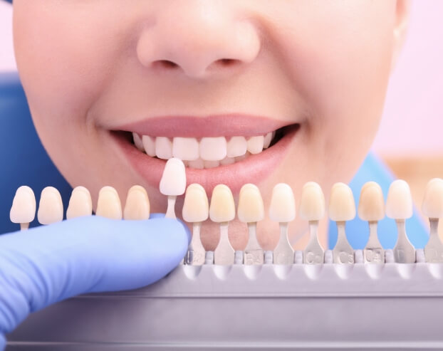 Smile compared to tooth colored filling shade chart