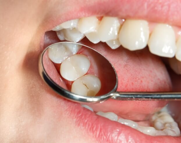 Dentist examining patient's smile after dental sealant application