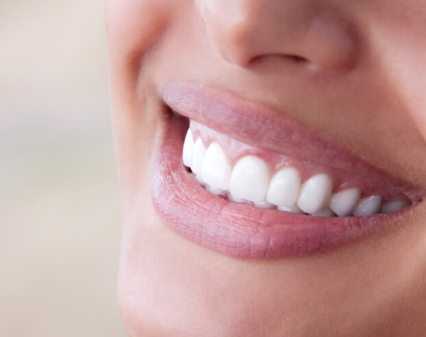Woman with flawless smile after porcelain veneers