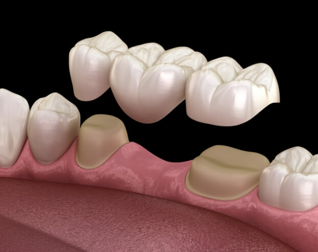 Animated smile during fixed bridge placement