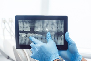 Dentist showing X-Rays