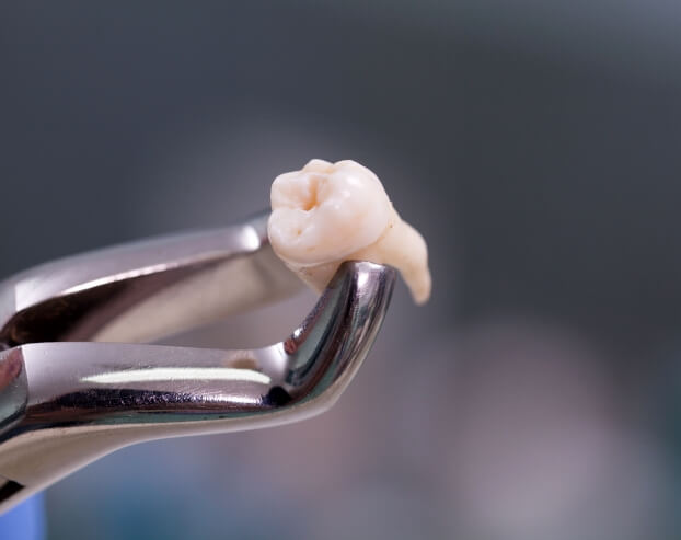 Metal clasp holding an extracted tooth