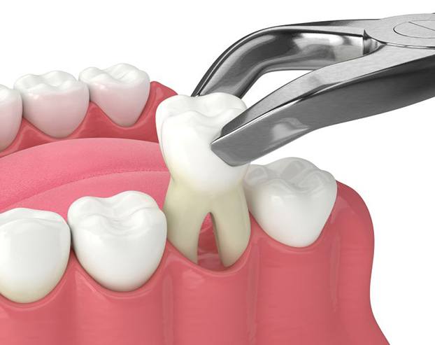 Illustration of forceps removing tooth