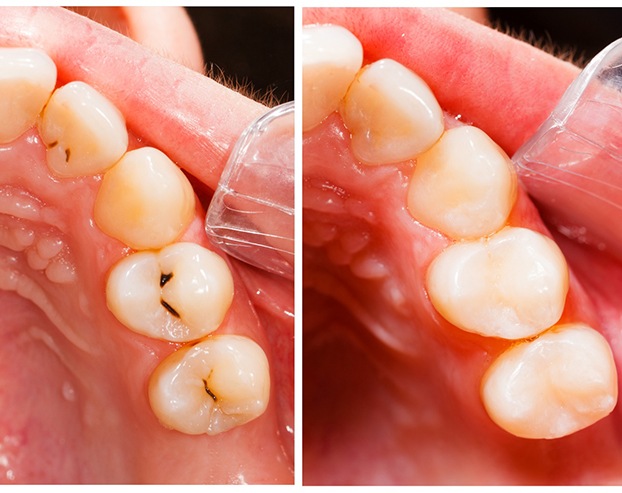 a split-screen image of teeth before and after receiving fillings