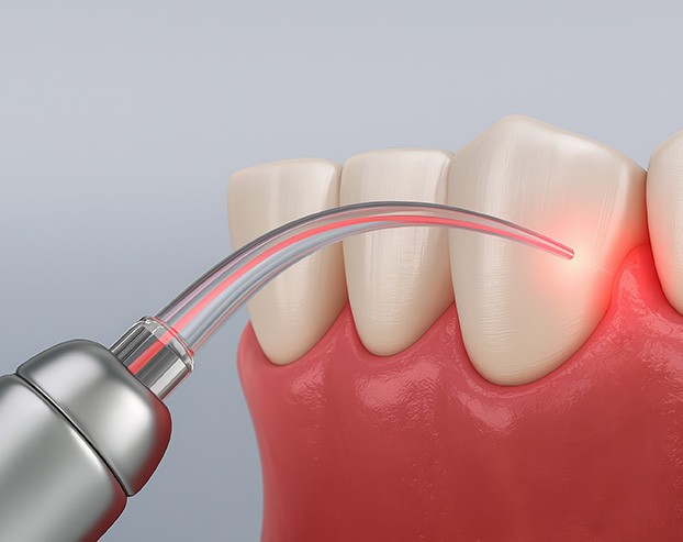 The benefits of gum recontouring include a less gummy smile and improved oral health