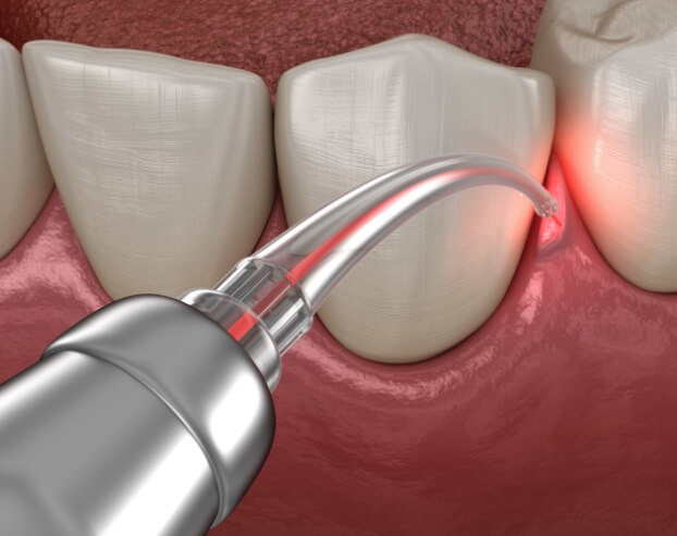 Animated smile during laser periodontal therapy