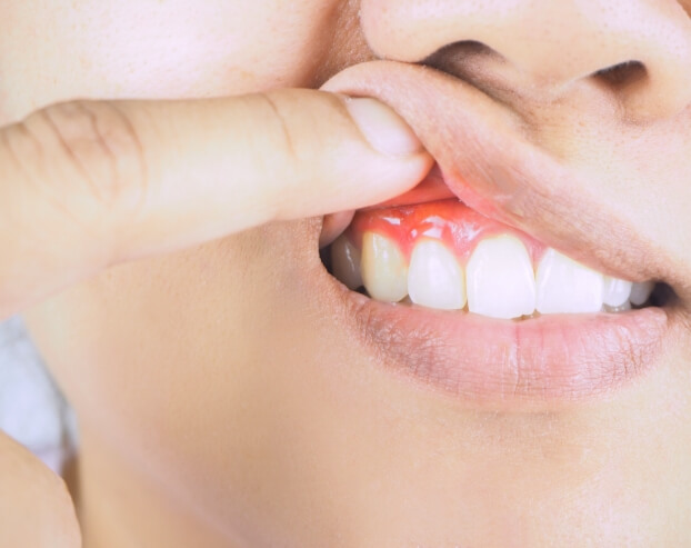 Patient with inflamed soft tissue being examined for gum disease