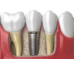 Digital illustration of single dental implant