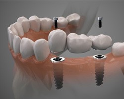 Digital illustration of a dental implant bridge