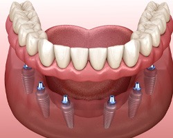 Digital illustration of a dental implant denture