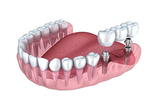 Dental implant-retained bridge