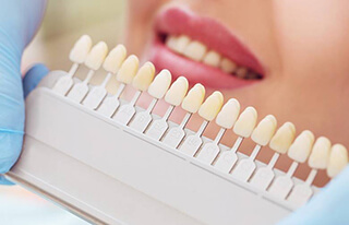 Crown Teeth Colour Chart