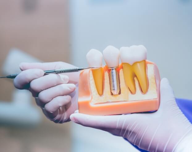Dentist pointing to model of dental implant supported dental crown