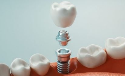 Animated smile during dental implant supported dental crown placement