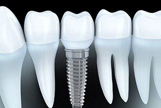 dental implant in Downtown Boston between natural teeth 
