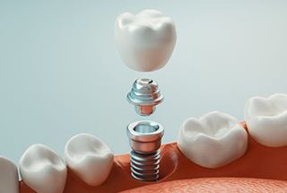 dental implant with abutment and crown 