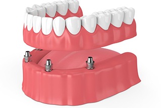 implant denture being placed on bottom arch 
