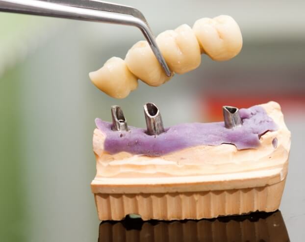 Model of smile with dental implant supported bridge