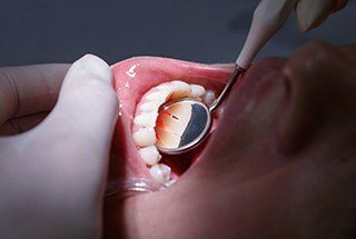 Closeup of patient during periodontal screening