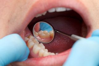 Closeup of teeth during dental exam