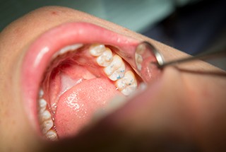 Closeup of teeth following filling placement