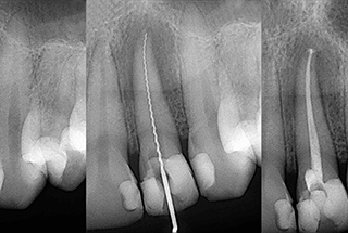 Root canal x-rays