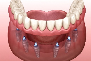Illustration of implant-retained dentures