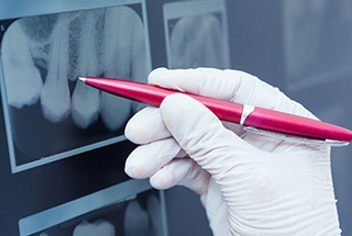 Pen pointing to spot on dental x-ray