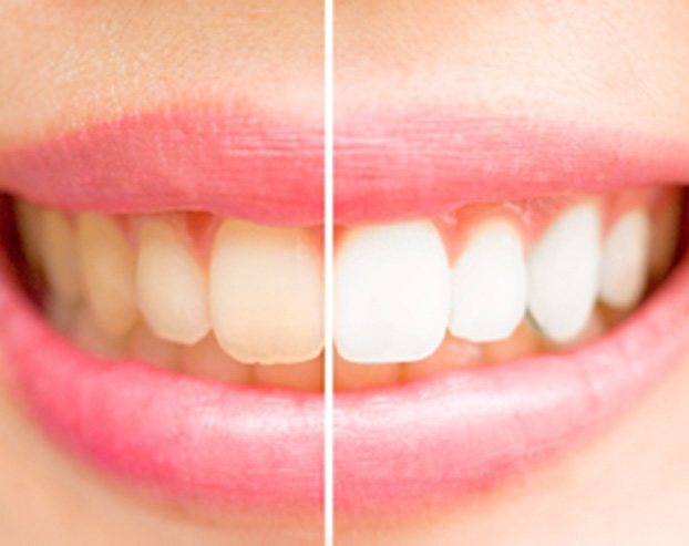 Before and after of teeth whitening in Boston