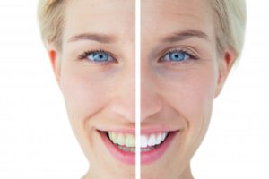 improved smile from cosmetic dentistry