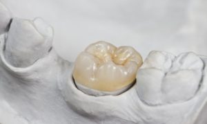 tooth colored dental crown white cast