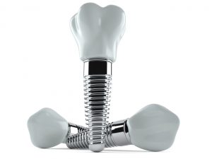 three dental implants