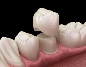 Closeup of animated model of dental crown.